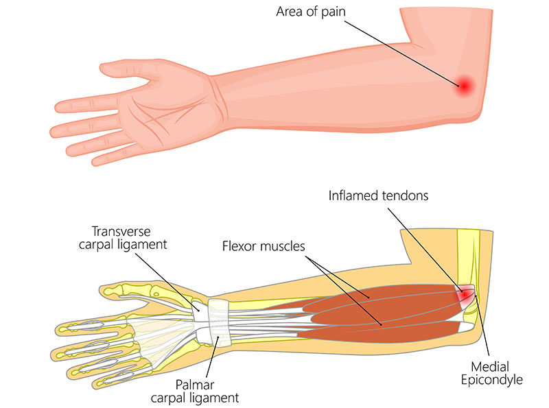 medial epikondilit