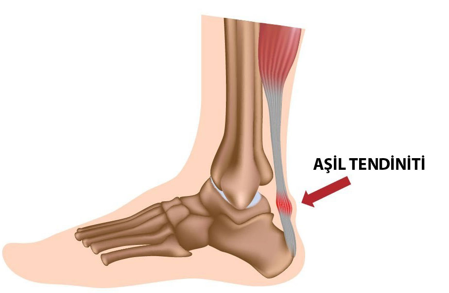 aşil tendinit