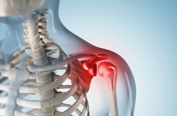 impingement sendromu