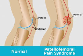 Patellofemoral Sendrom