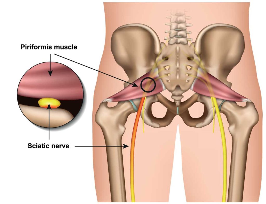 Priformis Sendromu