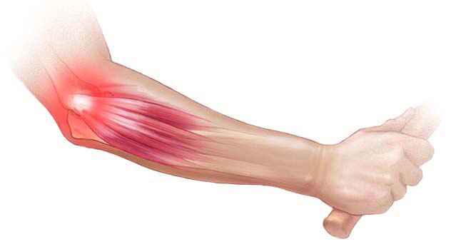 Lateral epikondilit