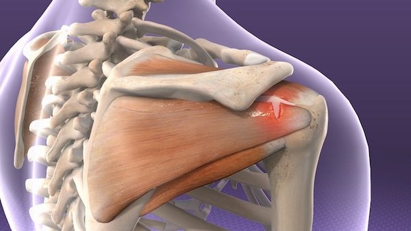 rotator cuff yırtığı